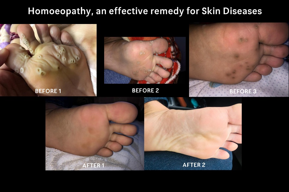 Homoeopathy, an effective remedy for Skin Diseases