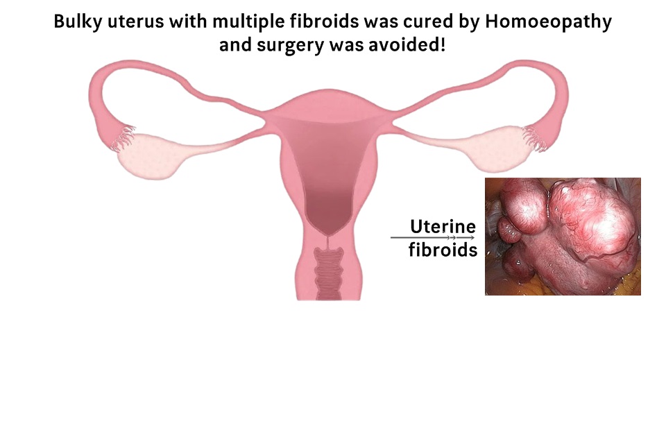 Bulky uterus with multiple fibroids was cured by Homoeopathy and surgery was avoided!