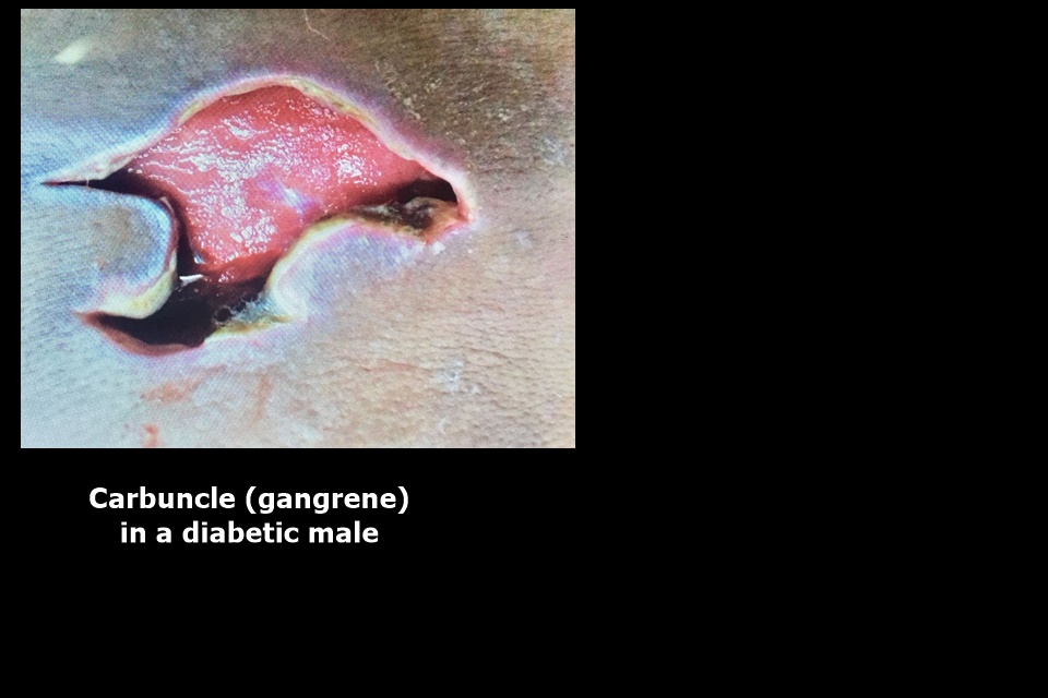 Carbuncle (gangrene) in a diabetic male