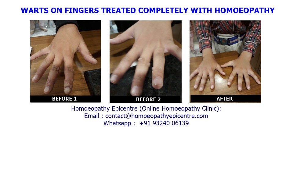 WARTS ON FINGERS TREATED COMPLETELY WITH HOMOEOPATHY