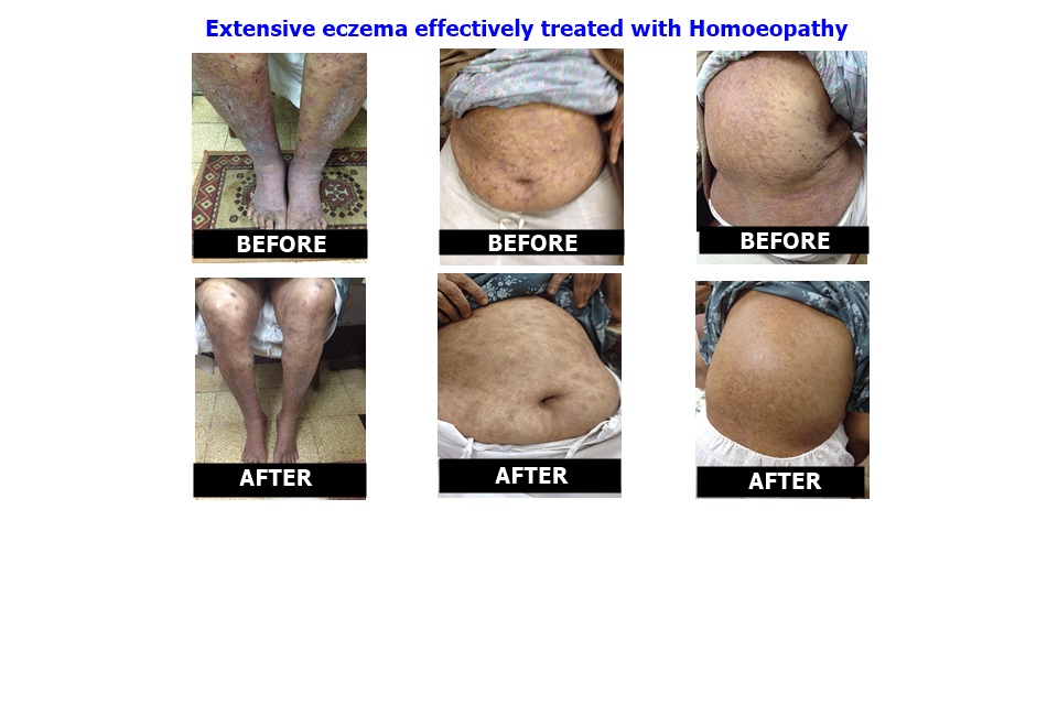 Extensive eczema effectively treated with Homoeopathy