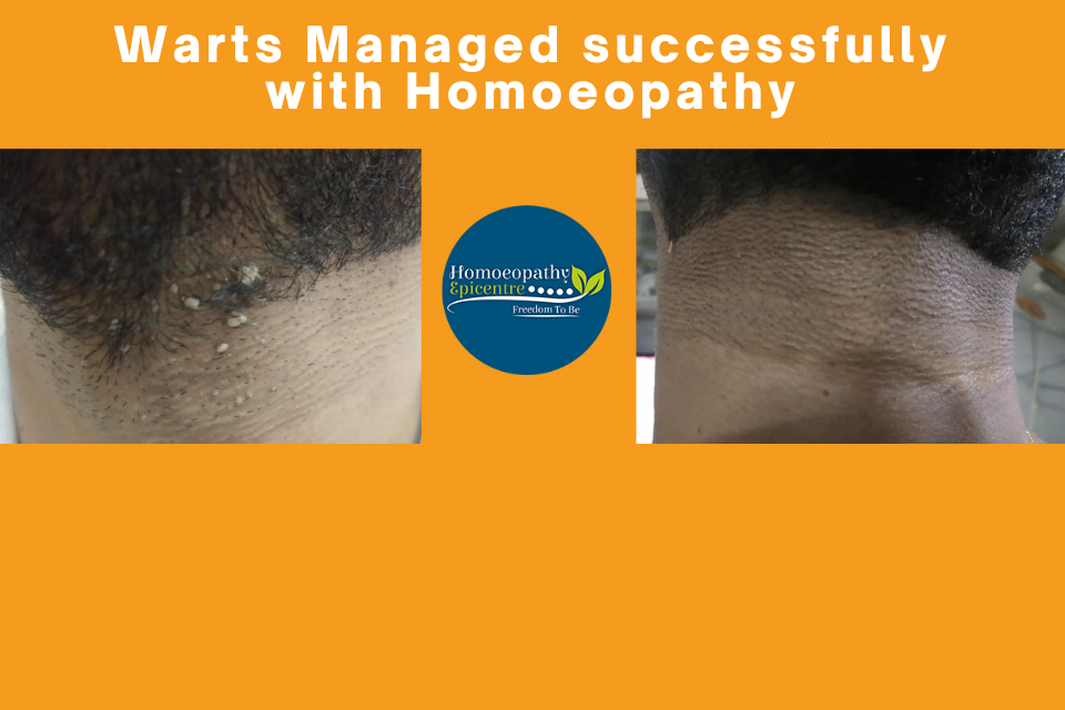 Warts Managed successfully with Homoeopathy