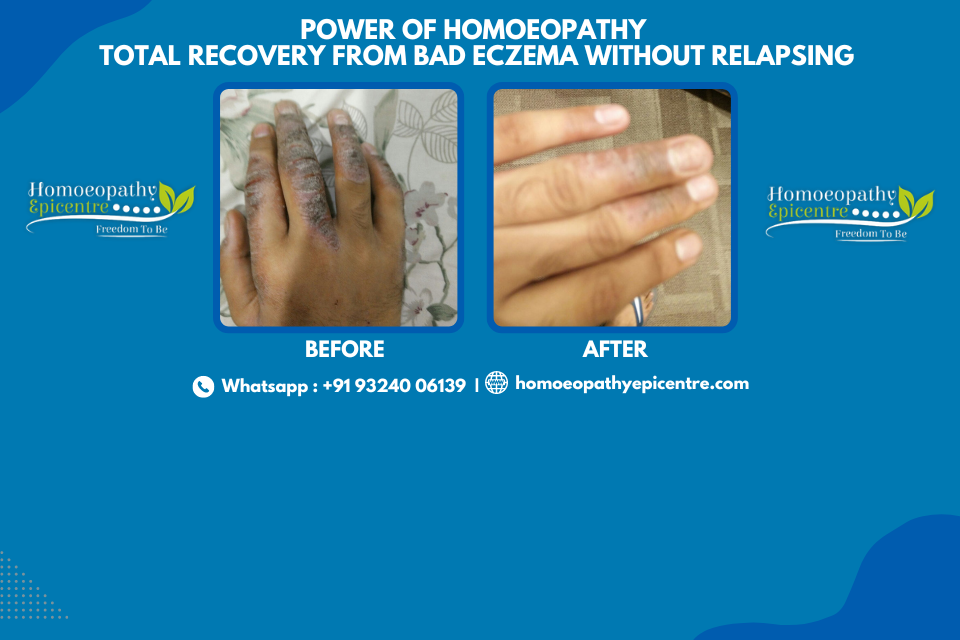 Homoeopathy in Bad Eczema – Part 2 | Total recovery from Bad Eczema without Relapsing.